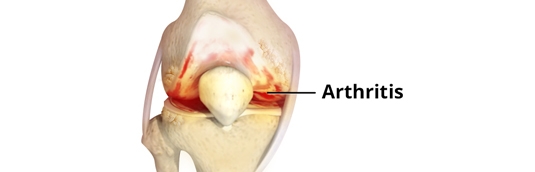 10 Signs of Knee Arthritis