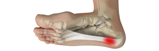 Common Cause of Heel Pain