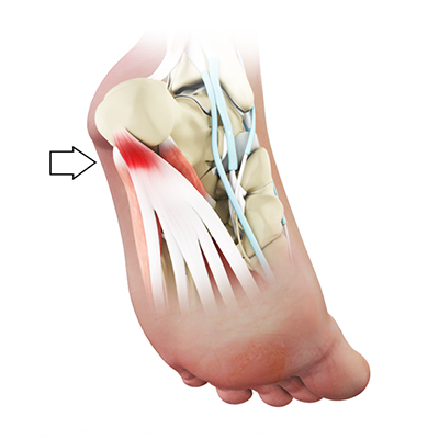 Plantar Fasciitis