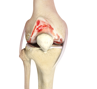 3D arthritis