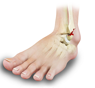 Ankle fracture