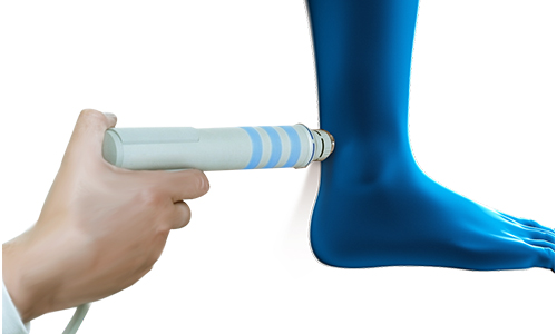 Shockwave Therapy for Achilles Tendon Pain