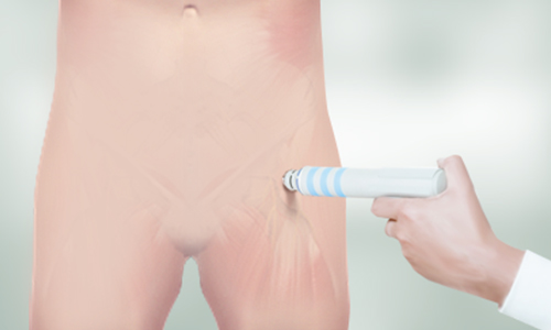 Shockwave Therapy for Hip Pain