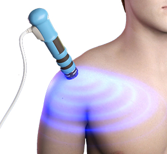 Shockwave Therapy for Shoulder Pain